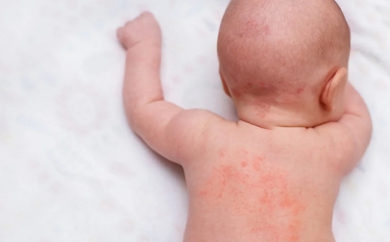 migrated 1790559220805 181 eczema baby2
